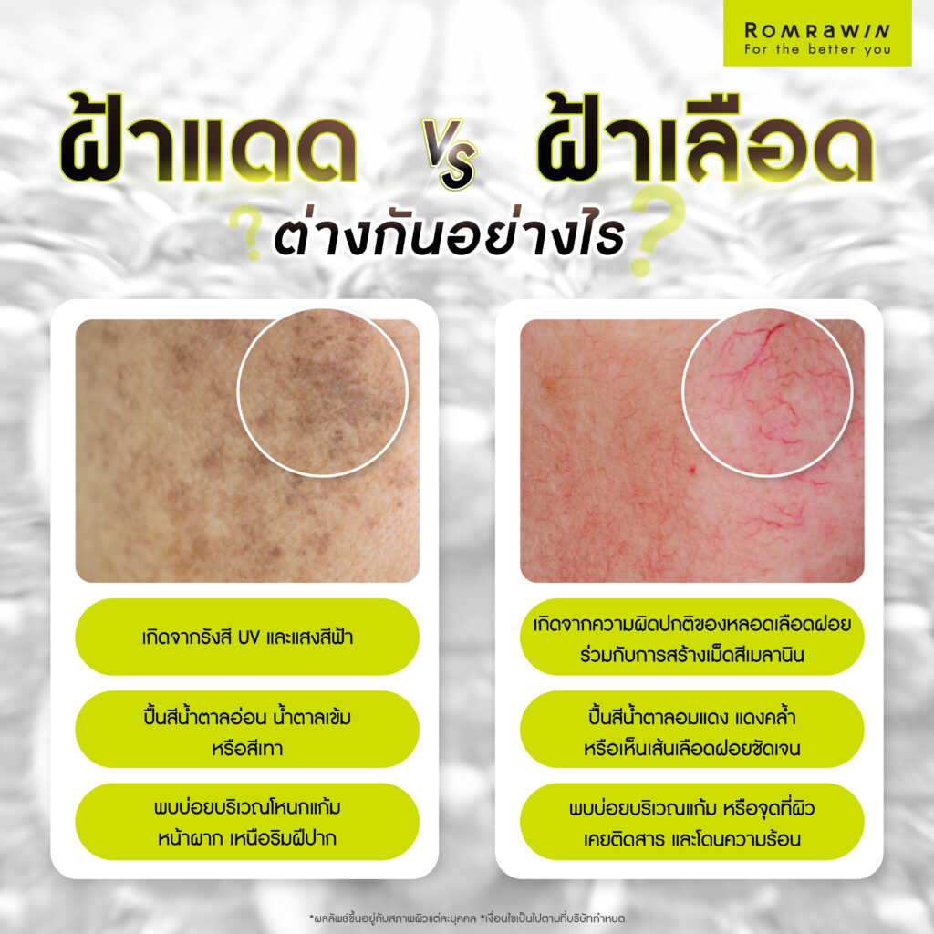 ฝ้าแดดกับฝ้าเลือดต่างกันยังไง? รู้จักสาเหตุ วิธีสังเกต และแนวทางรักษาฝ้า 2 ฝ้าแดดกับฝ้าเลือดต่างกันยังไง?