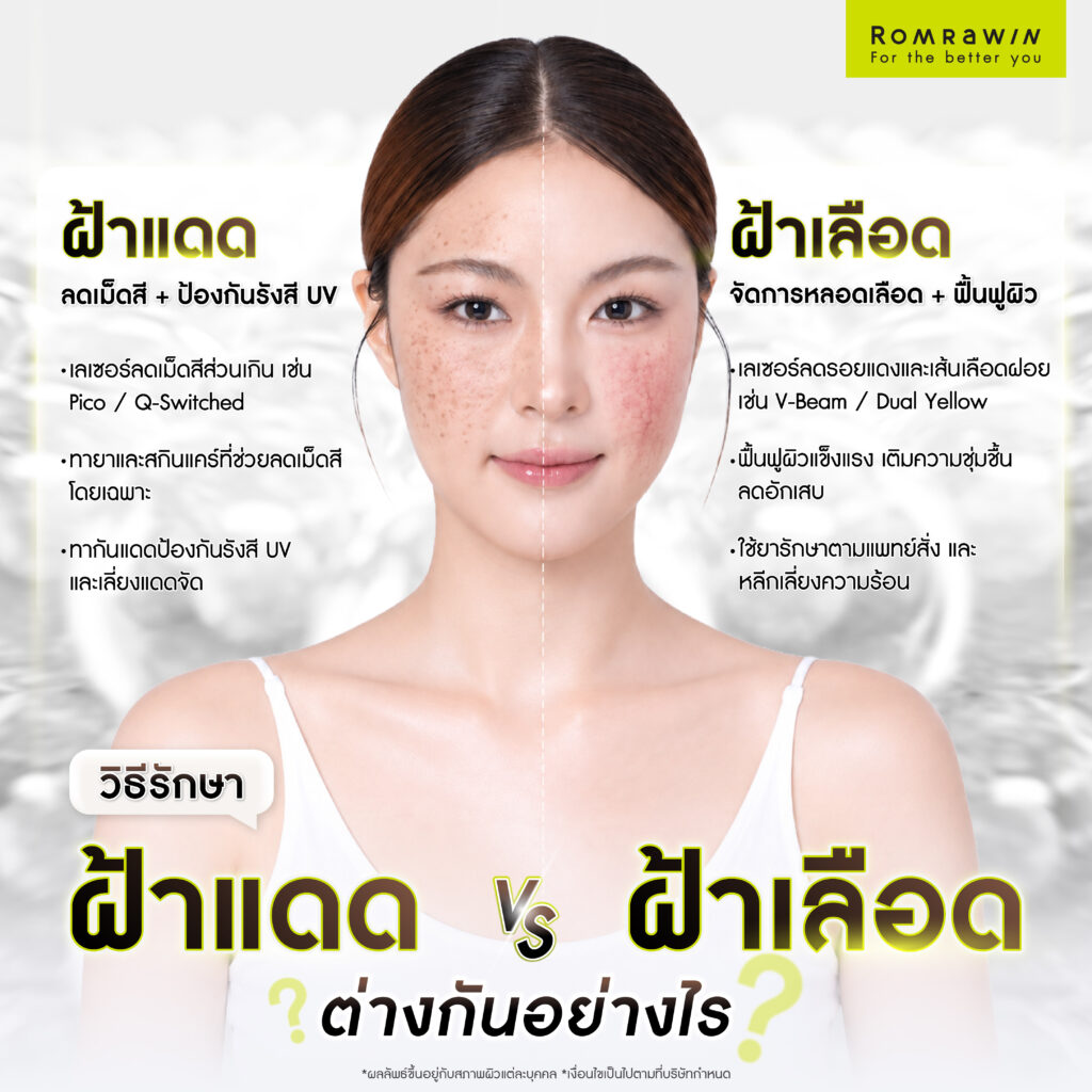 ฝ้าแดดกับฝ้าเลือดต่างกันยังไง? รู้จักสาเหตุ วิธีสังเกต และแนวทางรักษาฝ้า 3 วิธีรักษาฝ้าแดดกับฝ้าเลือดต่างกันยังไง
