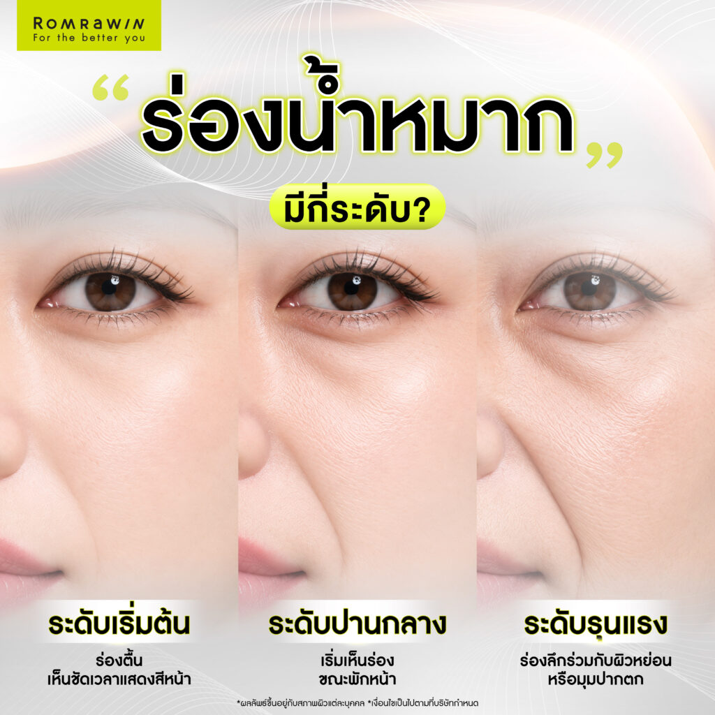 ร่องน้ำหมากคืออะไร? เกิดจากอะไร พร้อมวิธีแก้ด้วยเครื่องยกกระชับและโปรแกรมฉีดฟิลเลอร์ 2 ร่องน้ำหมากมีกี่ระดับ? สังเกตตัวเองได้อย่างไร