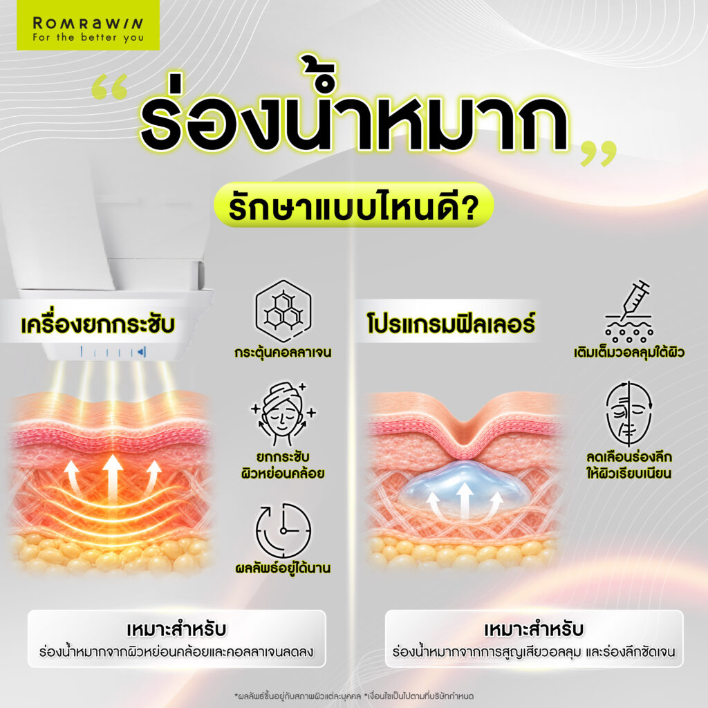 ร่องน้ำหมากคืออะไร? เกิดจากอะไร พร้อมวิธีแก้ด้วยเครื่องยกกระชับและโปรแกรมฉีดฟิลเลอร์ 3 ร่องน้ำหมากรักษาแบบไหนดี?