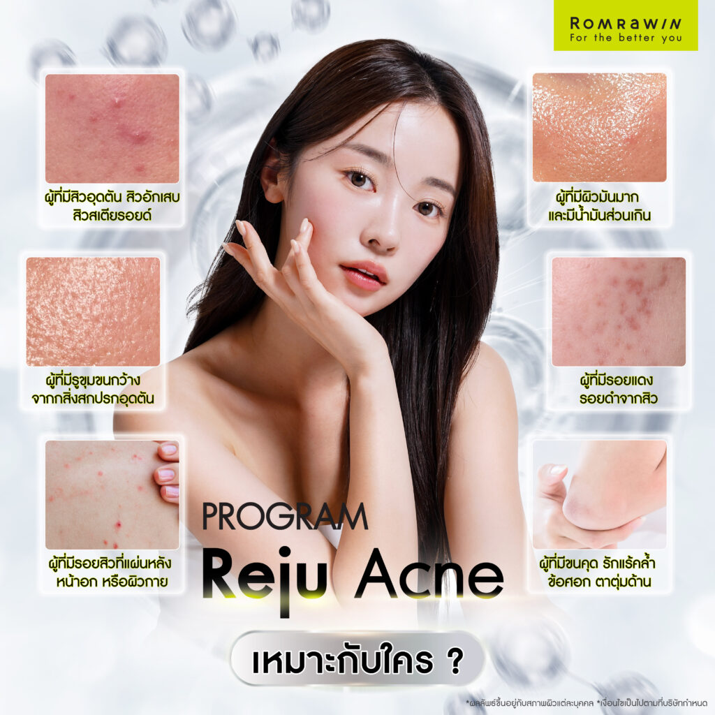 Reju Acne เคล็ดลับเคลียร์ปัญหาสิว พร้อมกู้ผิวหยาบกร้าน 3 Reju Acne เหมาะกับใคร?