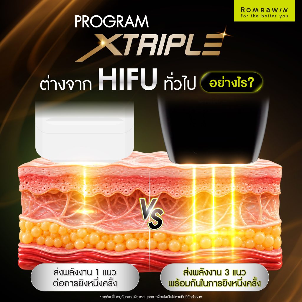 XTRIPLE คืออะไร? รู้จักเทคโนโลยียกกระชับ อื่นๆอย่างไร 3 XTRIPLE แตกต่างจาก HIFU ทั่วไปอย่างไร?