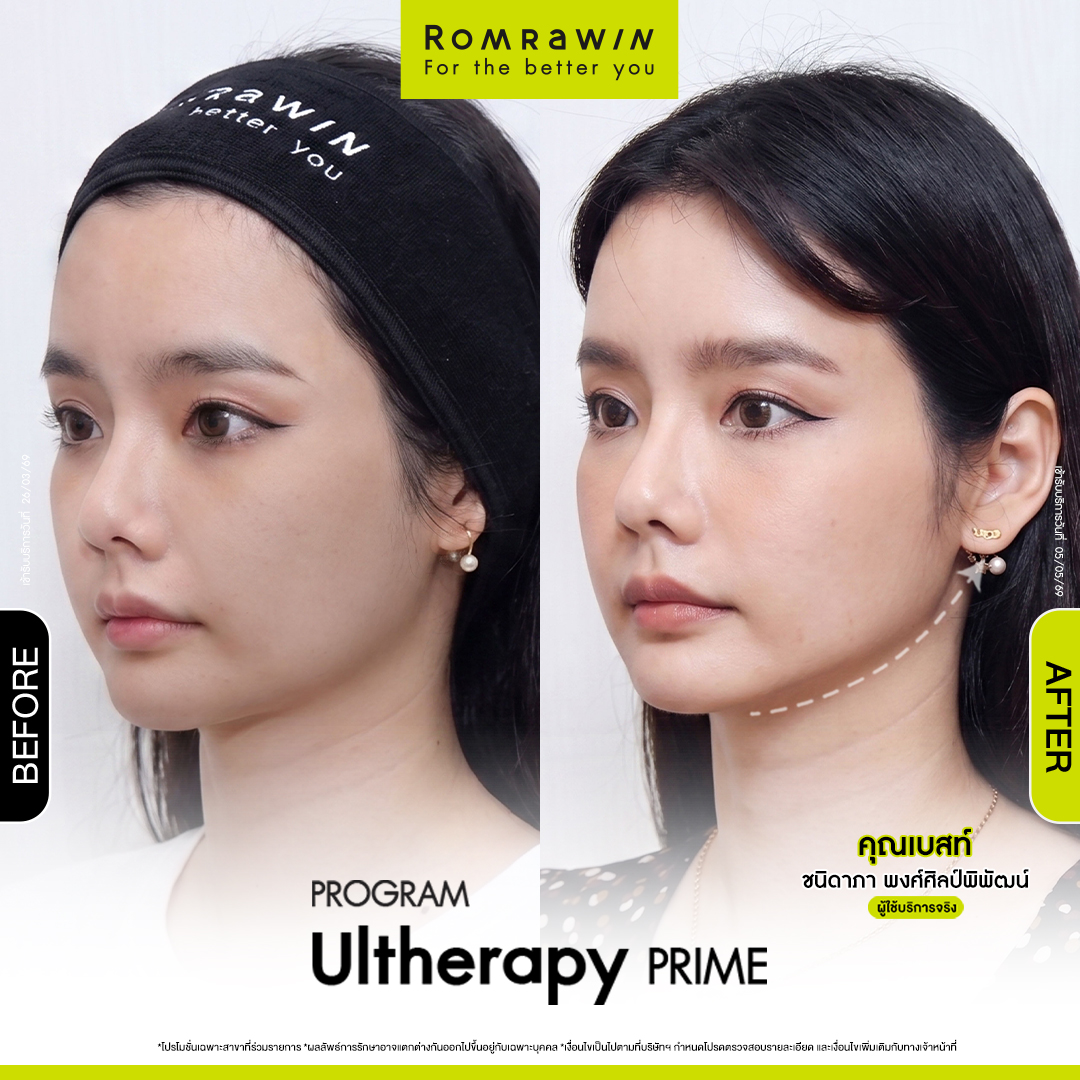 คุณเบสท์ ชนิดาภา เปิดเคล็ดลับหน้ายกกระชับด้วย Ultherapy PRIME 3 เบสท์ ชนิดาภา