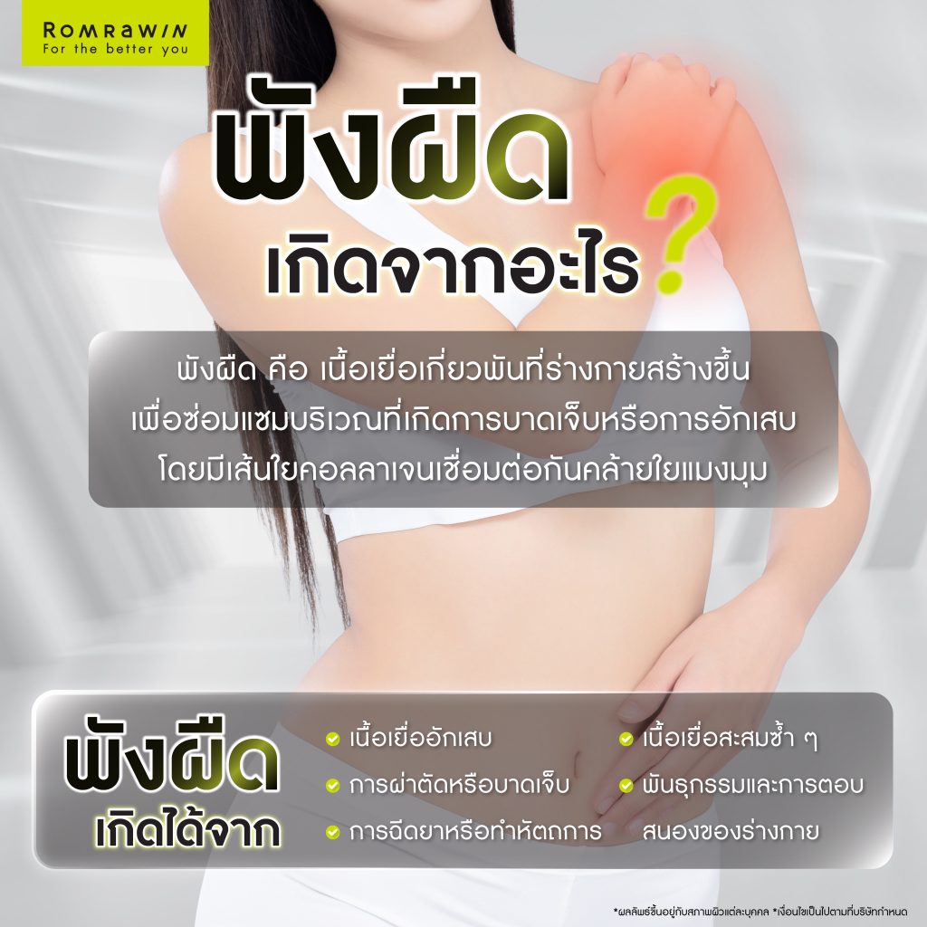 พังผืดเกิดจากอะไร? เช็กอาการ สาเหตุ และวิธีรักษาพังผืดที่ควรรู้ 2 สาเหตุของการเกิดพังผืด