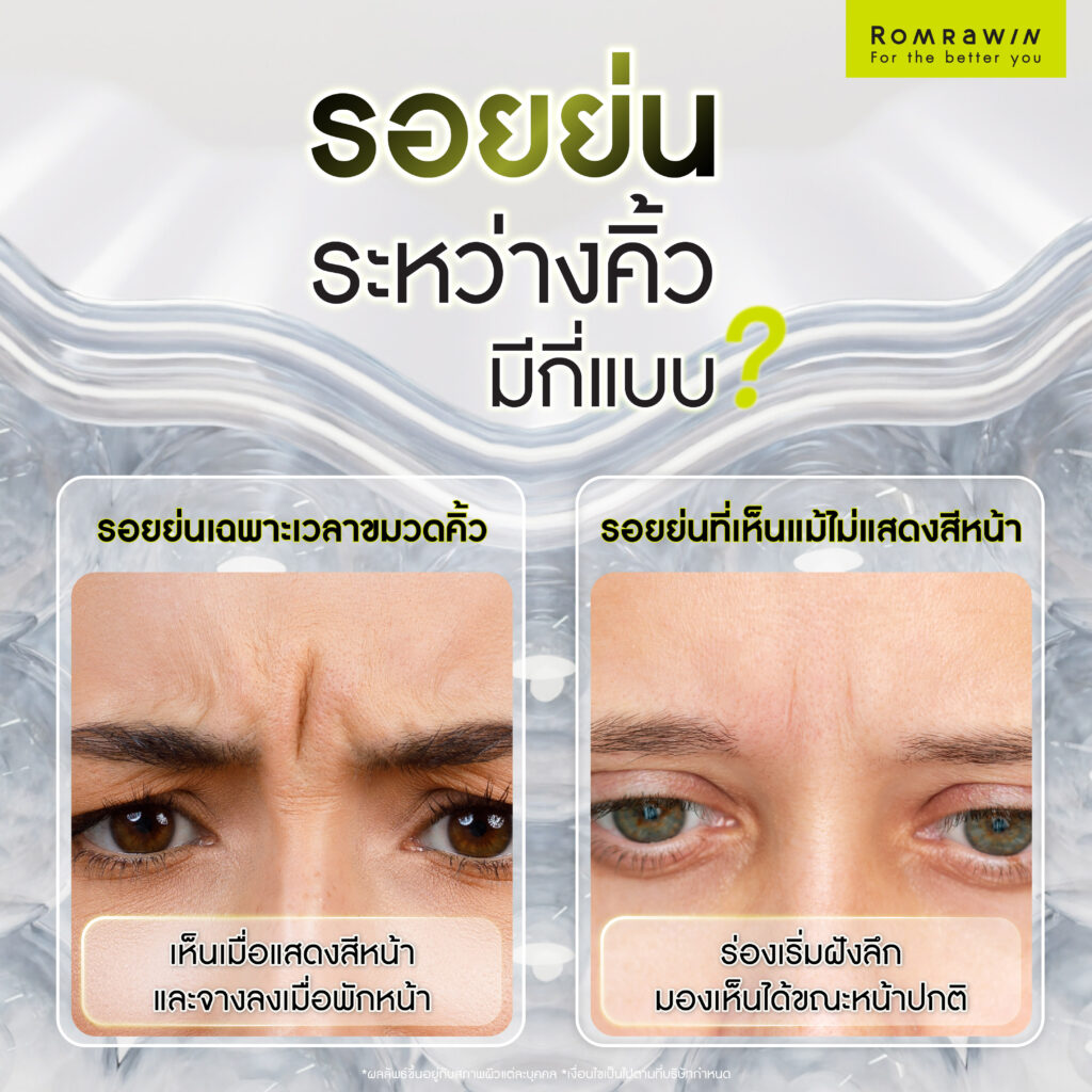 รอยย่นระหว่างคิ้วเกิดจากอะไร? เช็กสาเหตุ พร้อมวิธีลดริ้วรอยให้เหมาะกับแต่ละปัญหา 3 รอยย่นระหว่างคิ้วมีกี่แบบ?