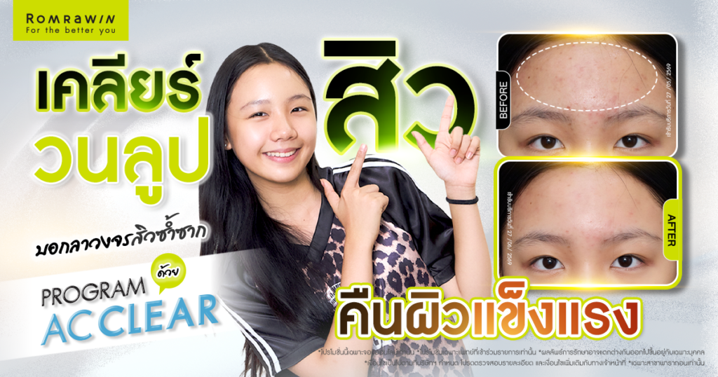 เคลียร์สิว หน้าใส มั่นใจเต็มที่ คุณมากิเลือกโปรแกรม AC CLEAR 1 เคลียร์สิว หน้าใส มั่นใจเต็มที่ มากิเลือกโปรแกรม AC CLEAR