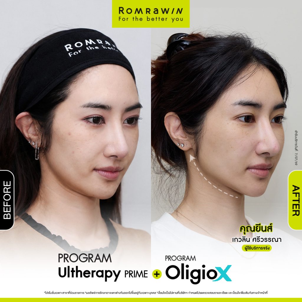 คุณยีนส์อัปหน้าให้ลีน ผิวเฟิร์มแรง ด้วย 2 พลังยกกระชับ 4 ยีนส์