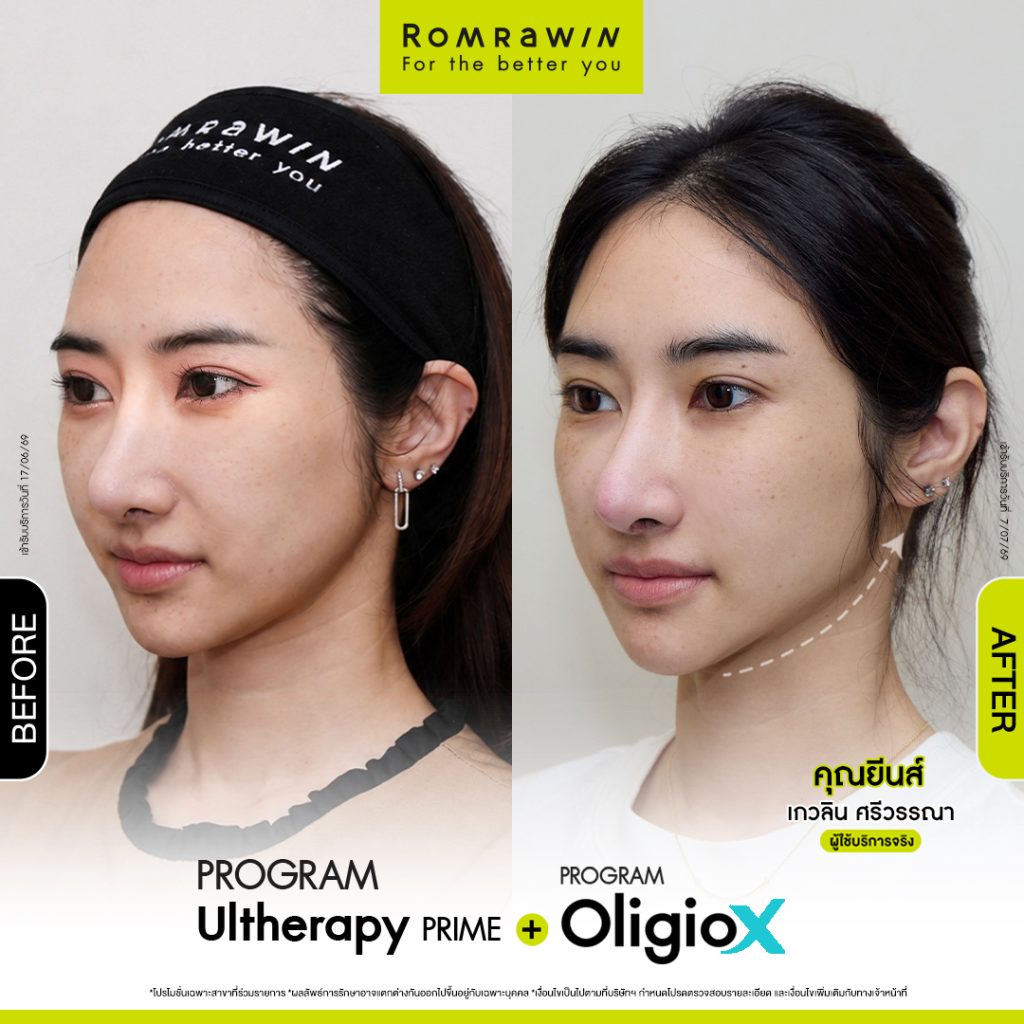 คุณยีนส์อัปหน้าให้ลีน ผิวเฟิร์มแรง ด้วย 2 พลังยกกระชับ 3 ยีนส์