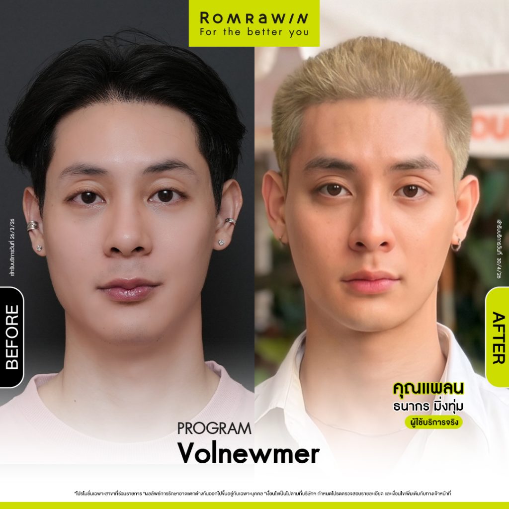 คุณแพลนอัปหน้ายก เติมผิวให้ฟูด้วยโปรแกรม Volnewmer 2 แพลน