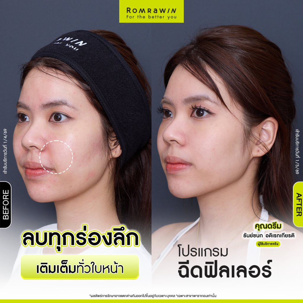 โปรแกรมฉีดฟิลเลอร์เติมเต็มใบหน้าของคุณดรีมให้ละมุน 3 ดรีม
