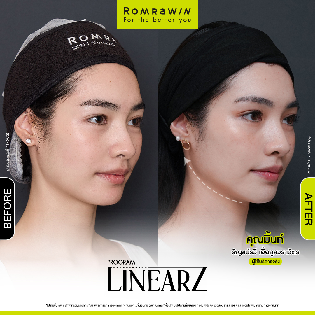 คุณมิ้นท์ รัญชน์รวี ดูแลกรอบหน้าให้กระชับด้วยโปรแกรม LINEAR Z 4 มิ้นท์ รัญชน์รวี