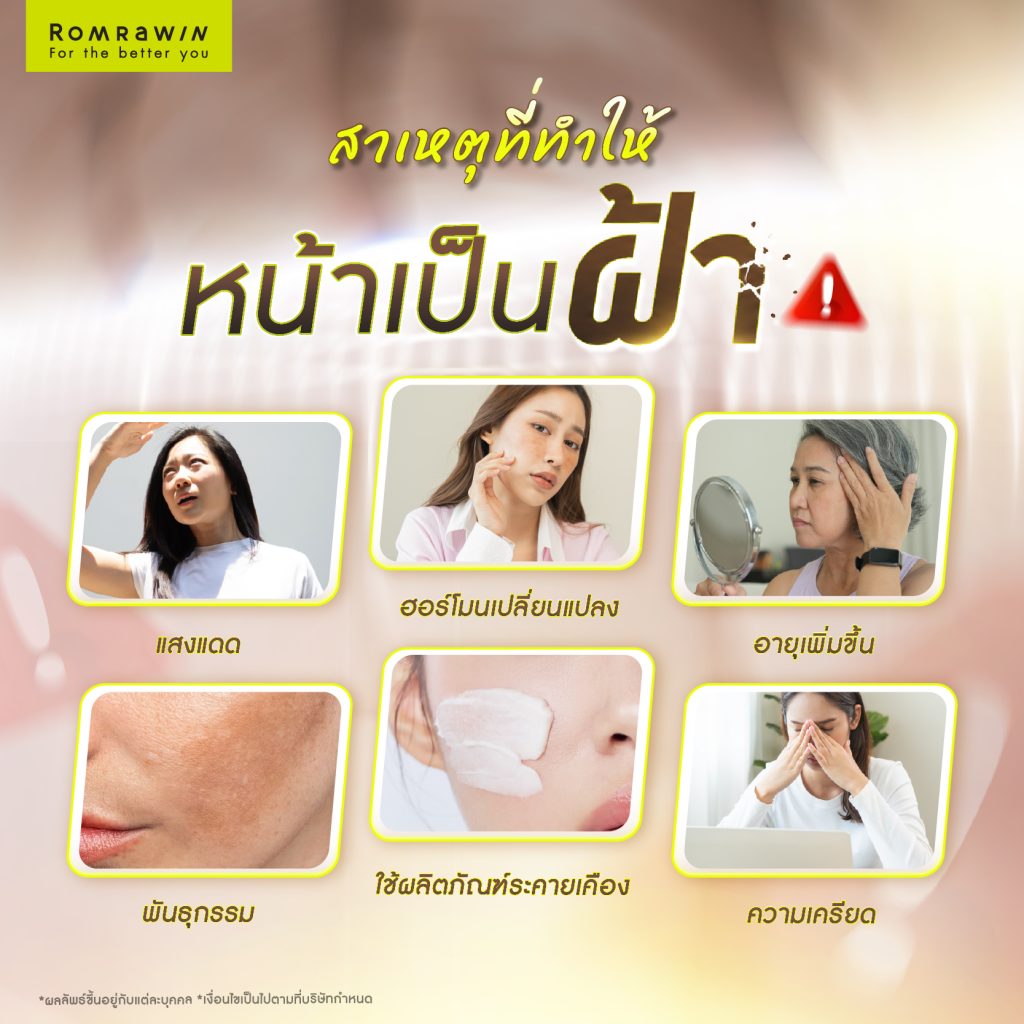 รู้จักสาเหตุที่ทำให้หน้าเป็นฝ้า