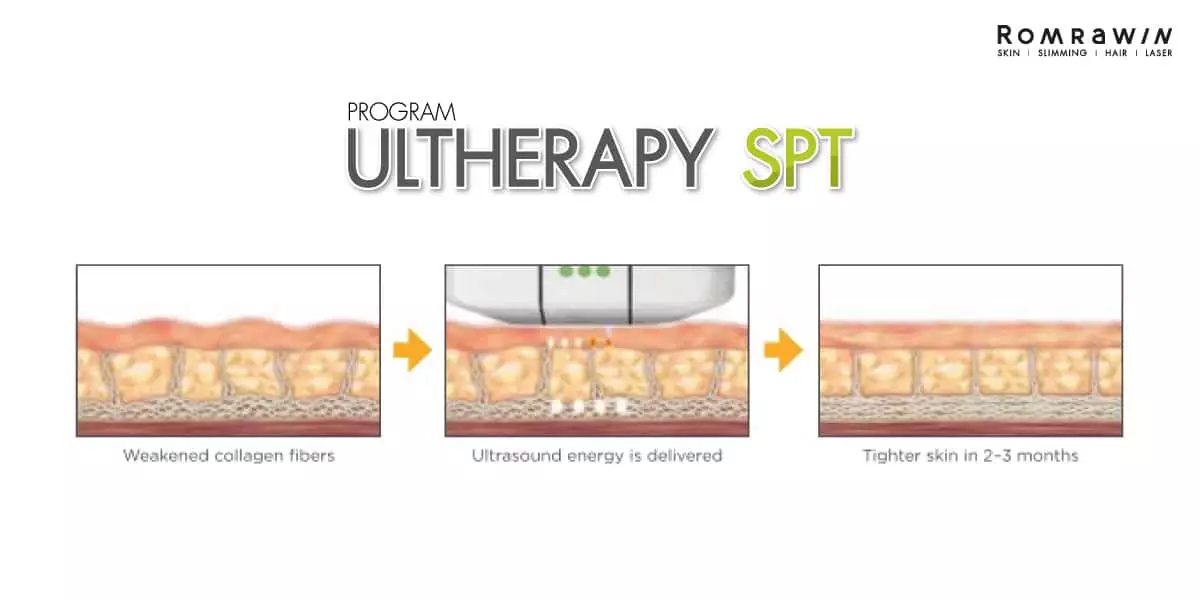 How to ultherapy