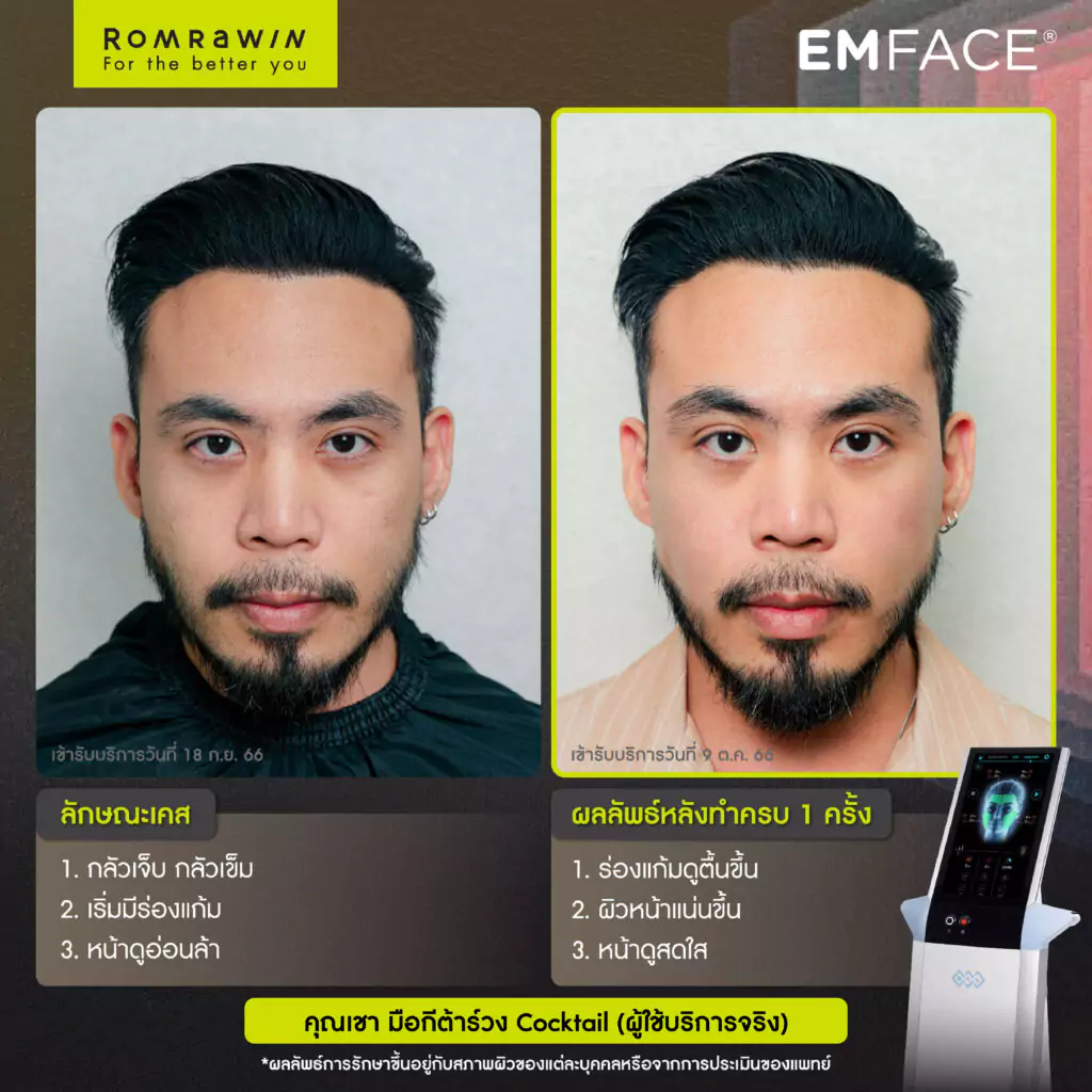 Emface คุณเชา มือกีตาร์วง Cocktail ผู้ใช้บริการจริง