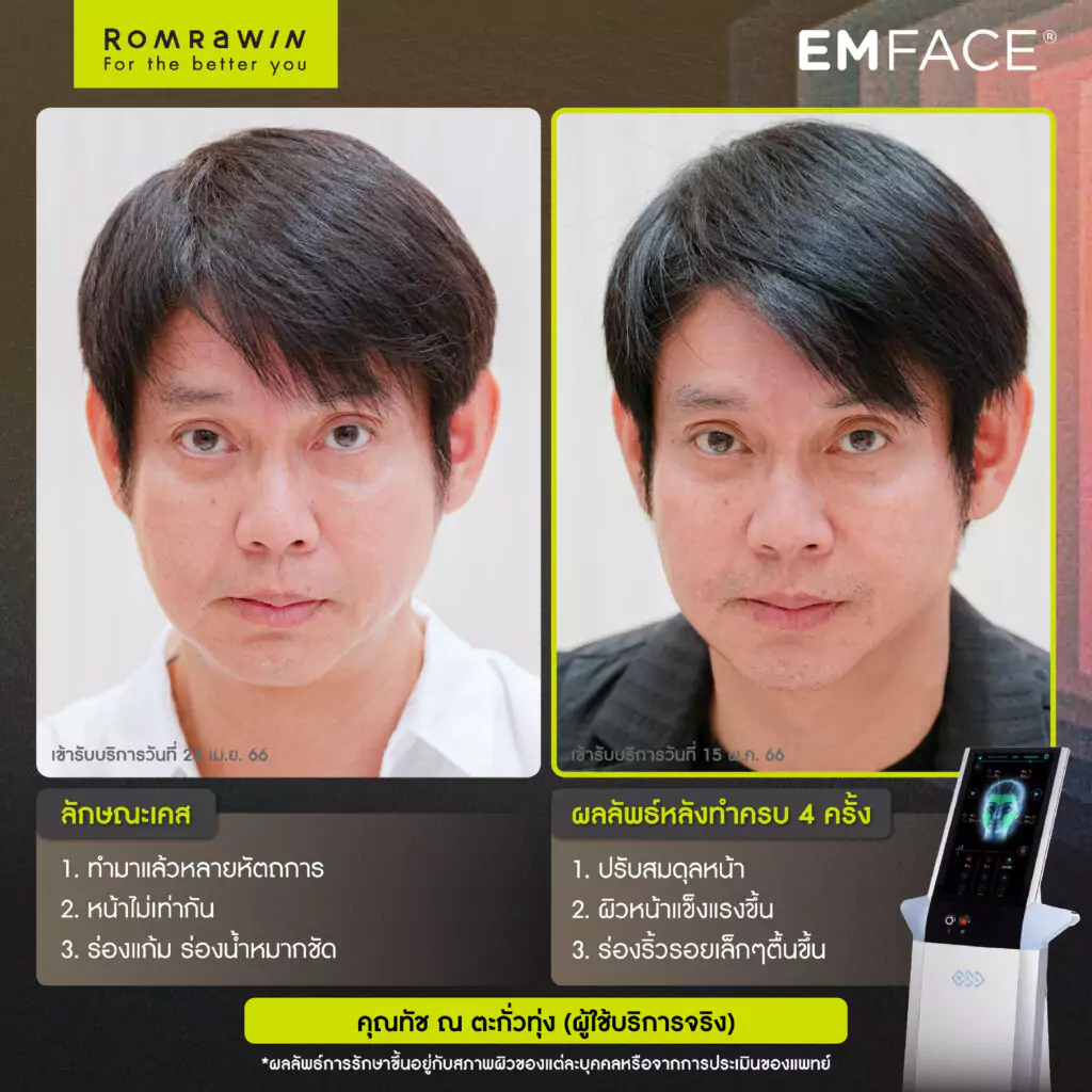 Emface คุณทัช ณ ตะกั่วทุ่ง ผู้ใช้บริการจริง
