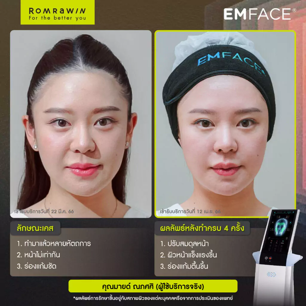 Emface คุณมาย ณภัศศิ ผู้ใช้บริการจริง