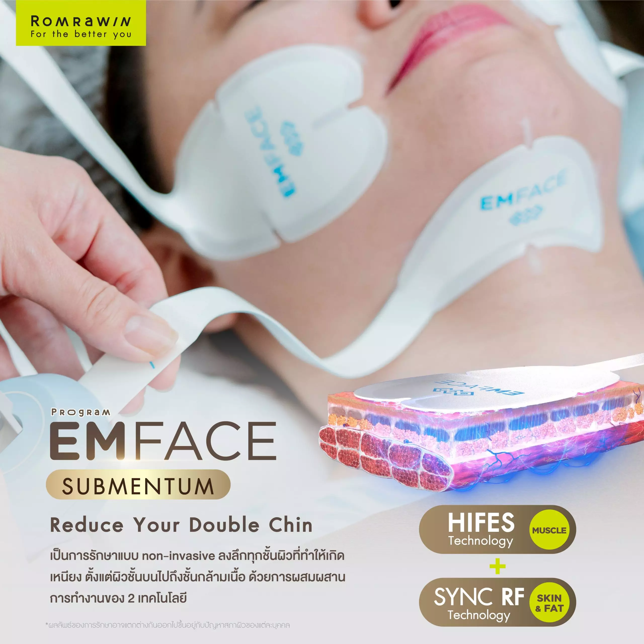 Emface Submentum ลดเหนียง คางสองชั้น 1 Emface submentum