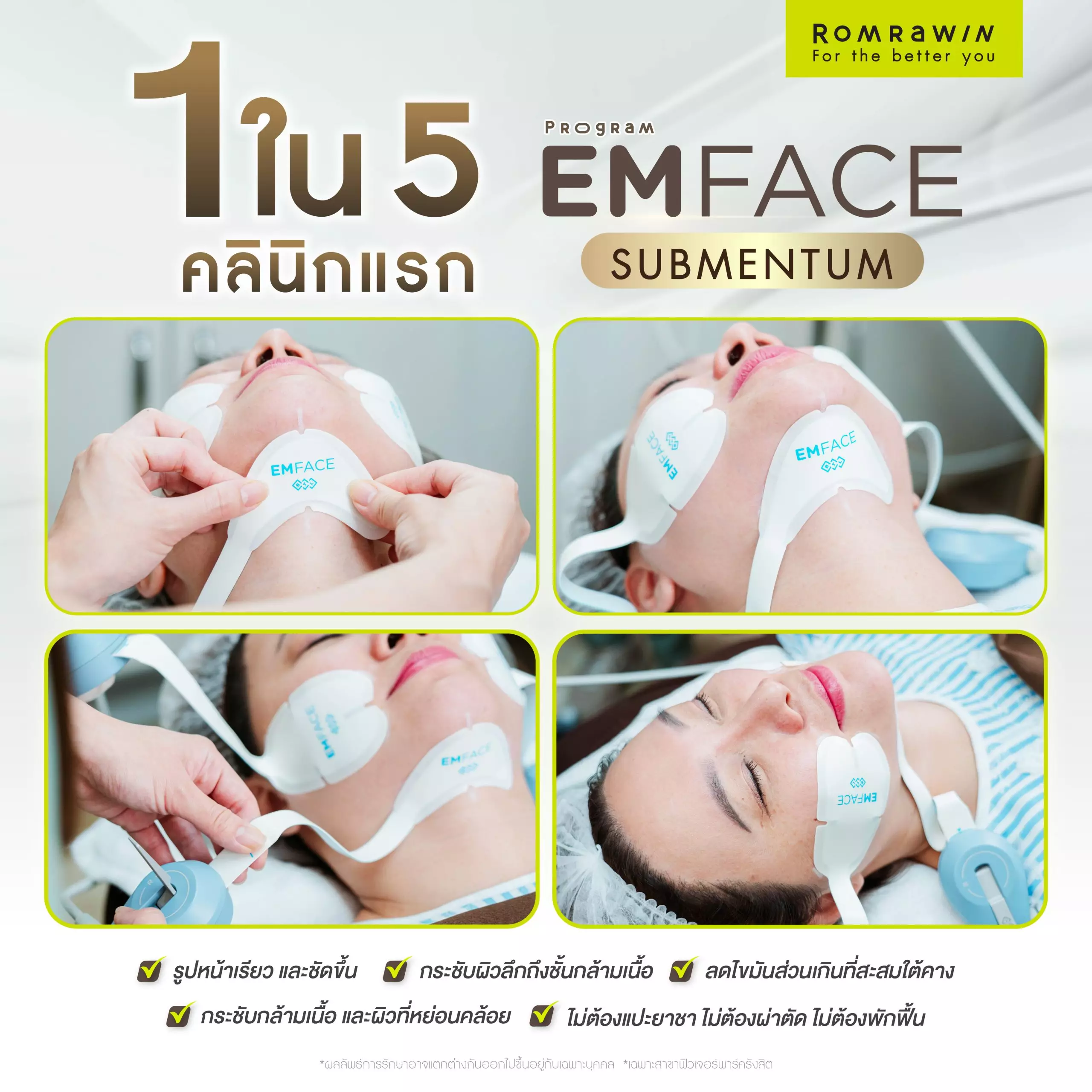 รูปภาพรีวิว Emface Submentum ก่อนและหลังการรักษา