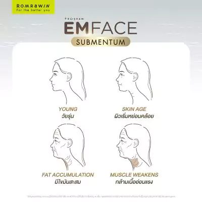 Emface Submentum เก็บเหนียง หน้ายก คืออะไร? เหมาะกับใคร ? 8 Emface Submentum