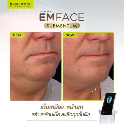Emface Submentum เก็บเหนียง หน้ายก คืออะไร? เหมาะกับใคร ? 9 Emface Submentum