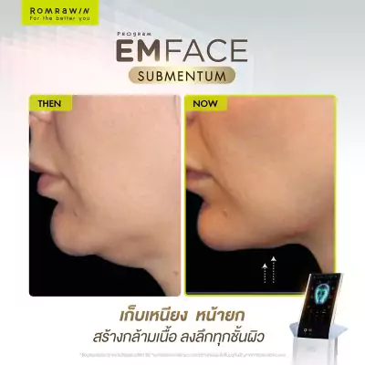 Emface Submentum เก็บเหนียง หน้ายก คืออะไร? เหมาะกับใคร ? 10 Emface Submentum
