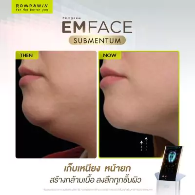 Emface Submentum เก็บเหนียง หน้ายก คืออะไร? เหมาะกับใคร ? 12 Emface Submentum