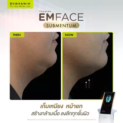 Emface Submentum เก็บเหนียง หน้ายก คืออะไร? เหมาะกับใคร ? 13 Emface Submentum