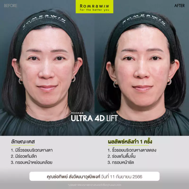 130824 BF AT Ultraformer MPT 4D Lift 02 0