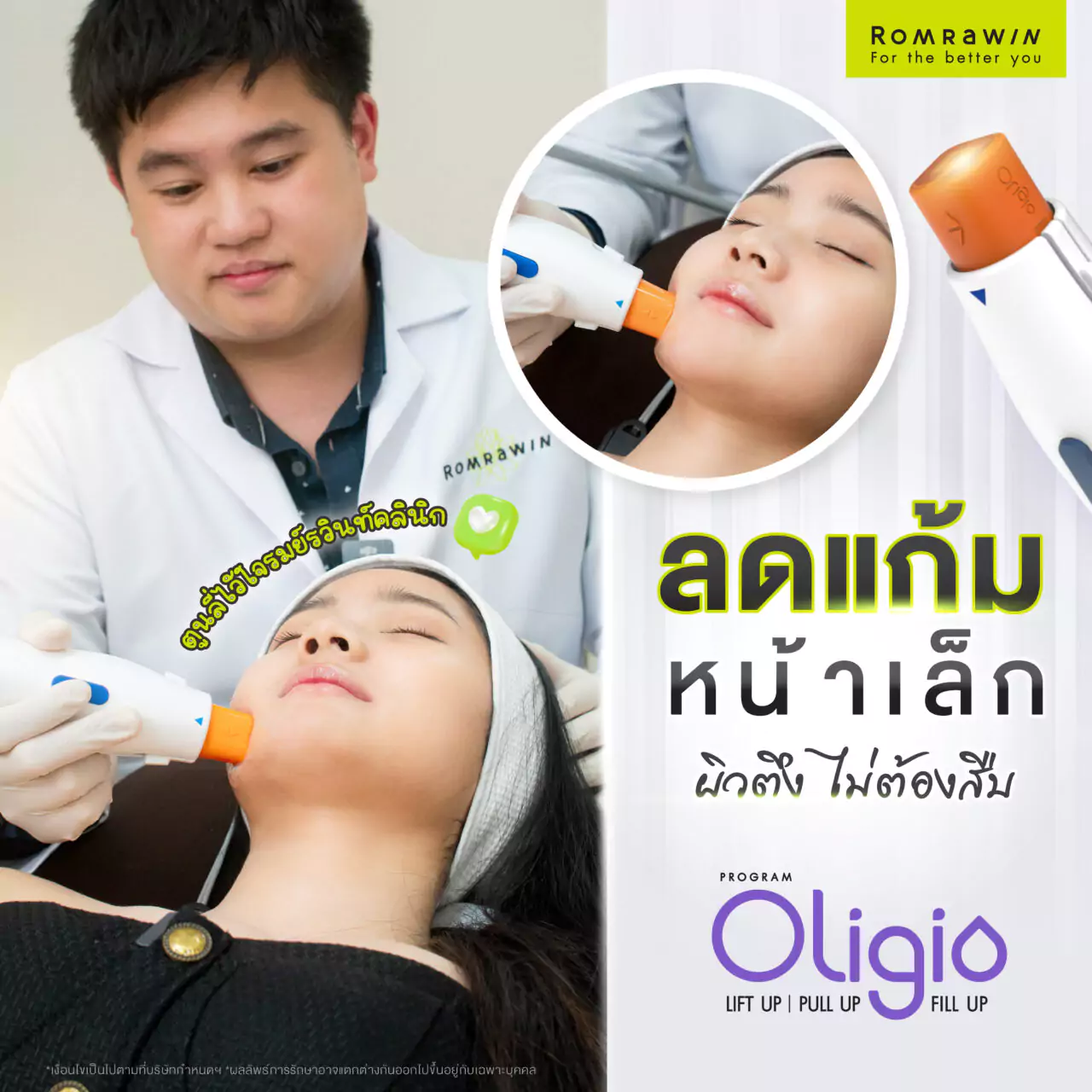 Oligio ช่วยลดแก้ม