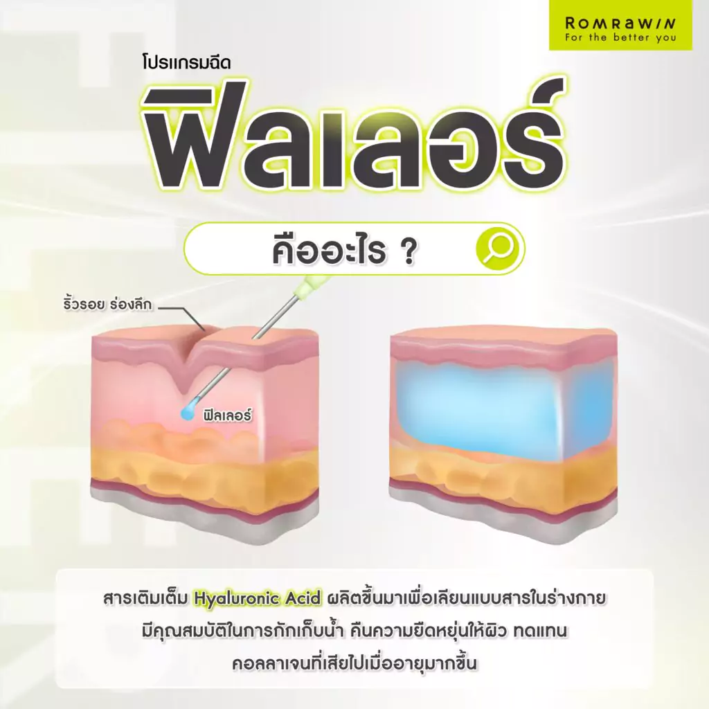 ฟิลเลอร์คืออะไร