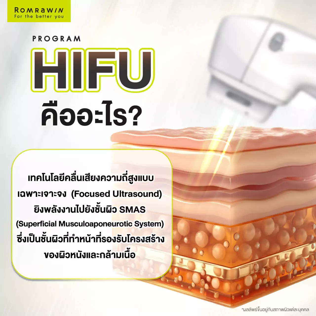 เทคโนโลยี HIFU คืออะไร?