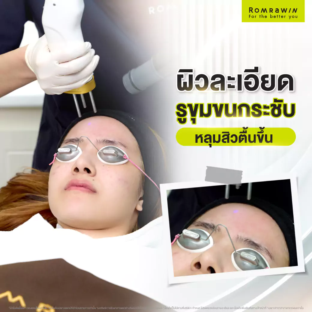 แก้ปัญหาหลุมสิว