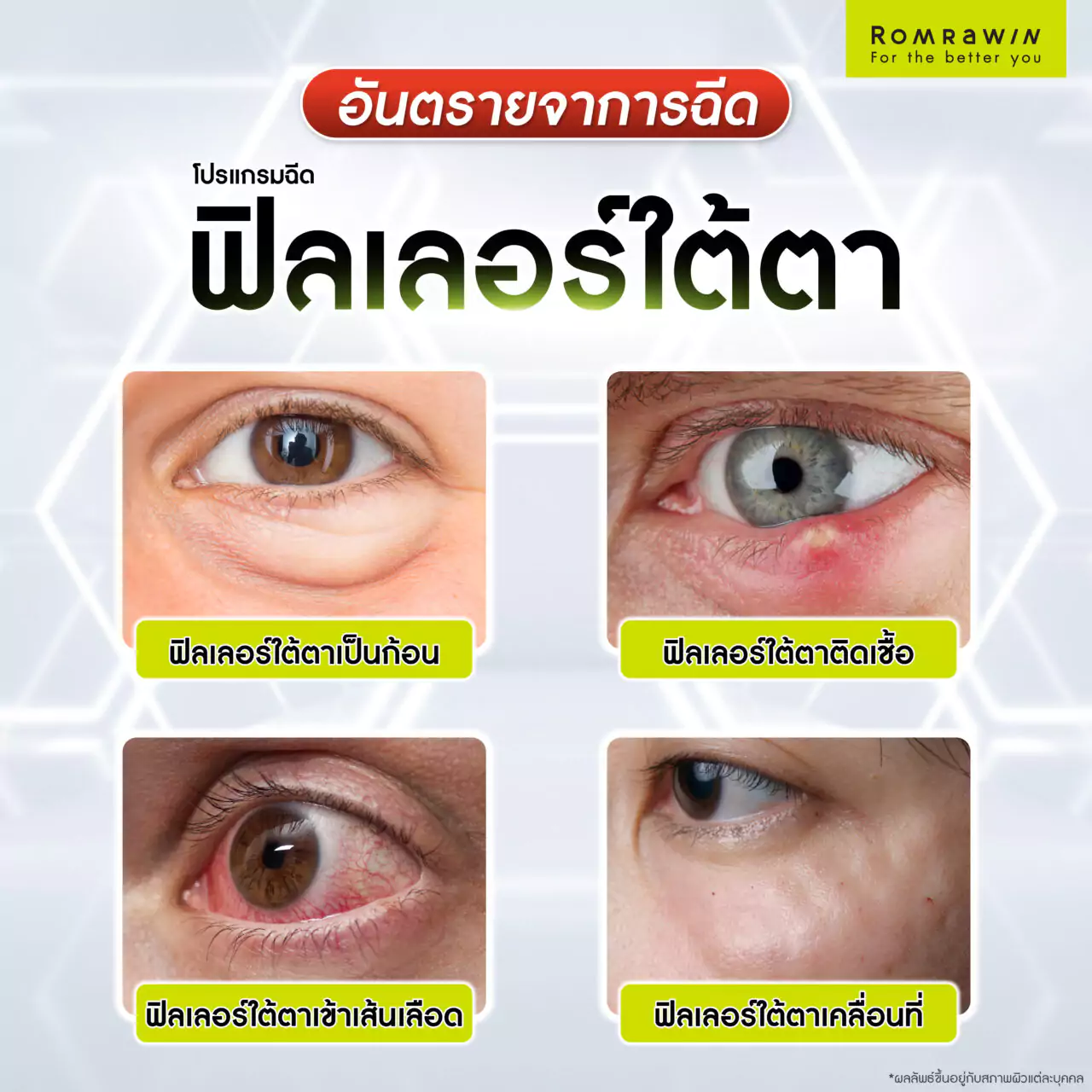 ปัญหาอันตรายจากการฉีดฟิลเลอร์ใต้ตา