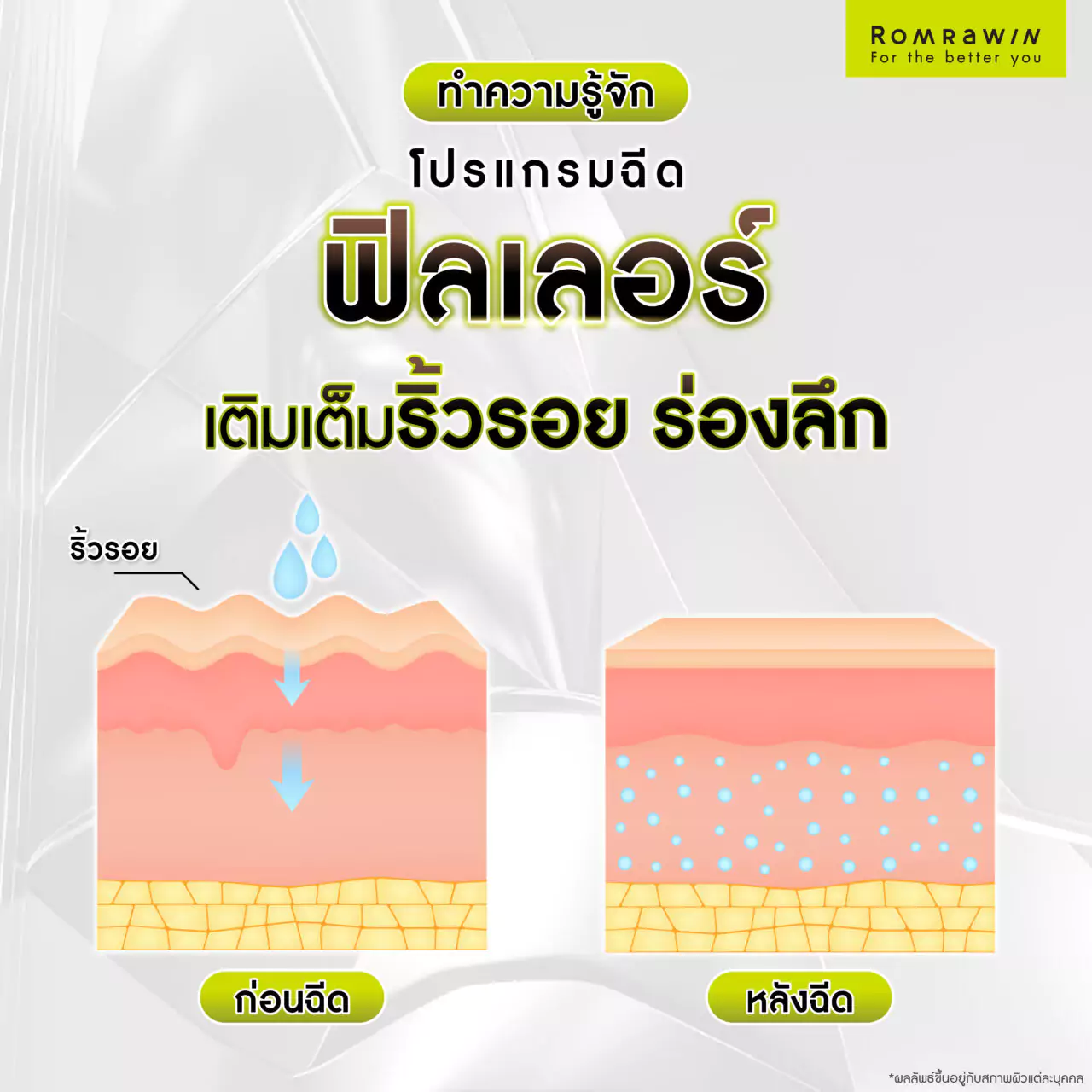 โปรแกรมฉีดฟิลเลอร์แก้ไขริ้วรอยได้จริงไหม? ก่อนฉีดควรรู้อะไรบ้าง? 2 ทำความรู้จัก โปรแกรมฉีดฟิลเลอร์เติมเต็มริ้วรอย