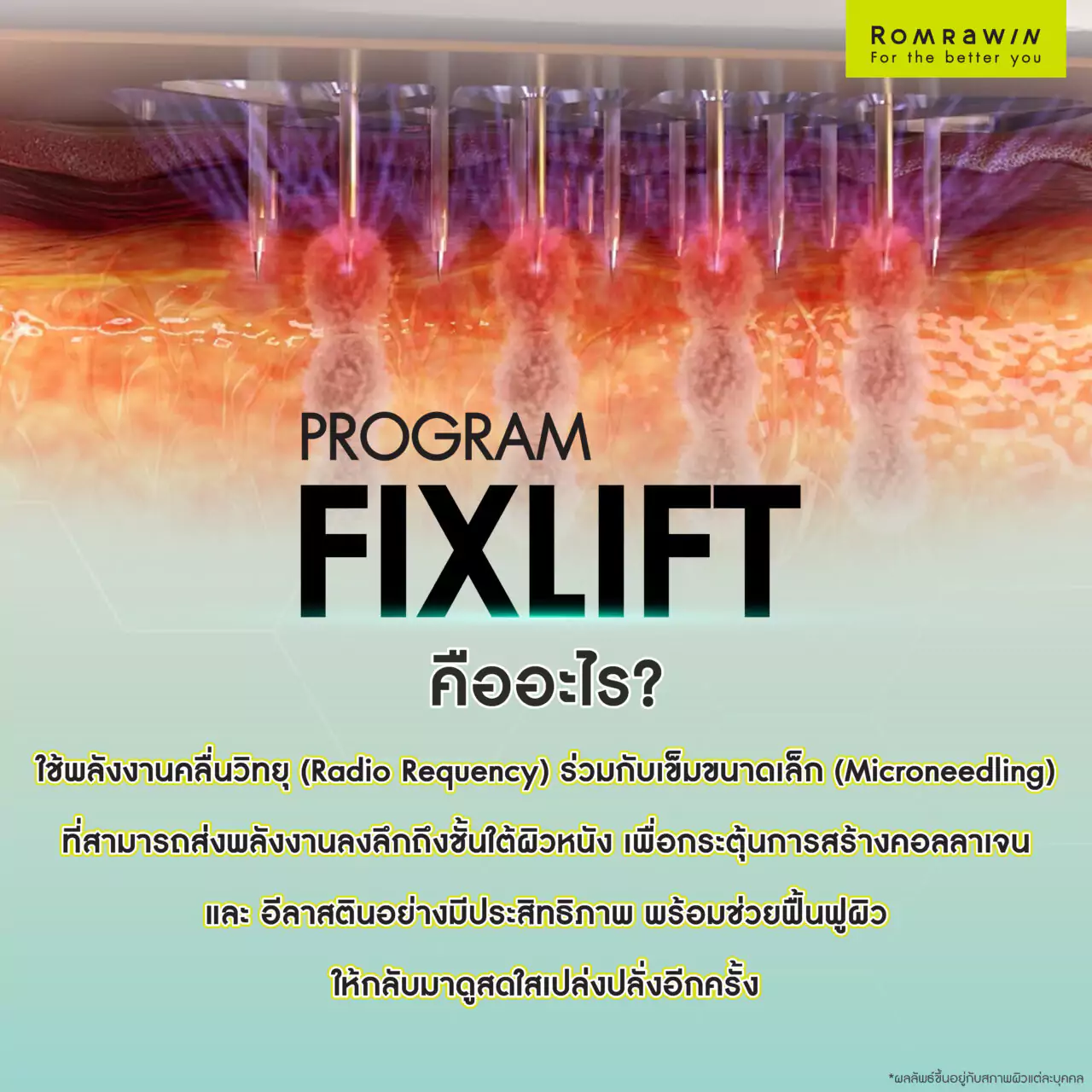 โปรแกรม Fix Lift ทางลัดสู่ผิวกระชับ อ่อนเยาว์ในแบบที่คุณต้องการ 2 โปรแกรม Fix Lift กู้ผิวยับ ยกผิวหย่อน คืออะไร?