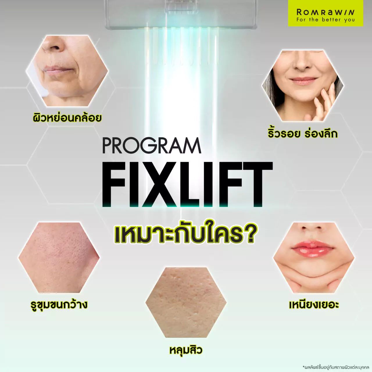 โปรแกรม Fix Lift ทางลัดสู่ผิวกระชับ อ่อนเยาว์ในแบบที่คุณต้องการ 6 ใครที่เหมาะกับโปรแกรม Fix Lift กู้ผิวยับ ยกผิวหย่อน บ้าง?