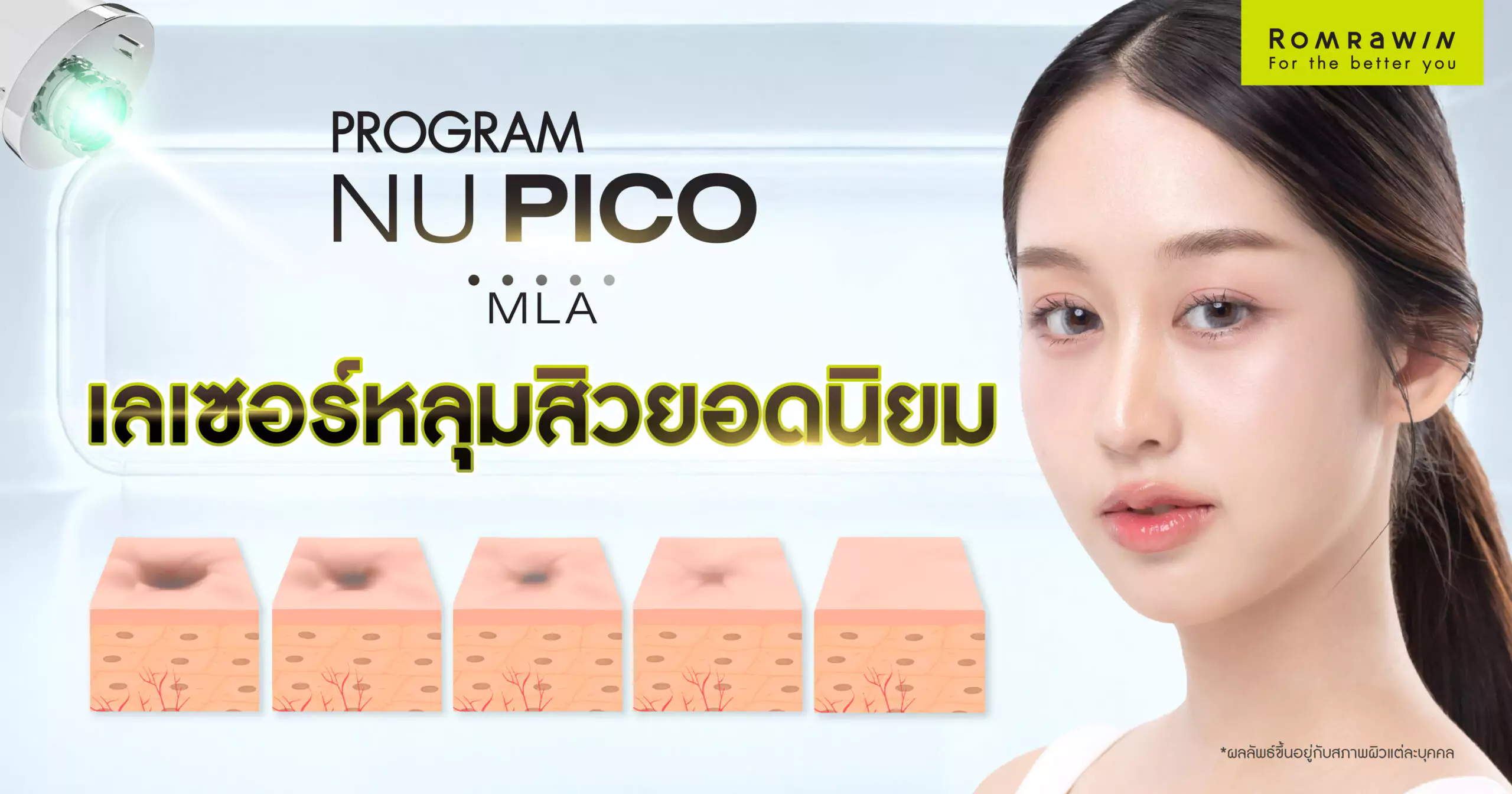 Nu Pico MLA เลเซอร์หลุมสิวยอดนิยมที่จัดการหลุมสิวได้ทุกประเภท