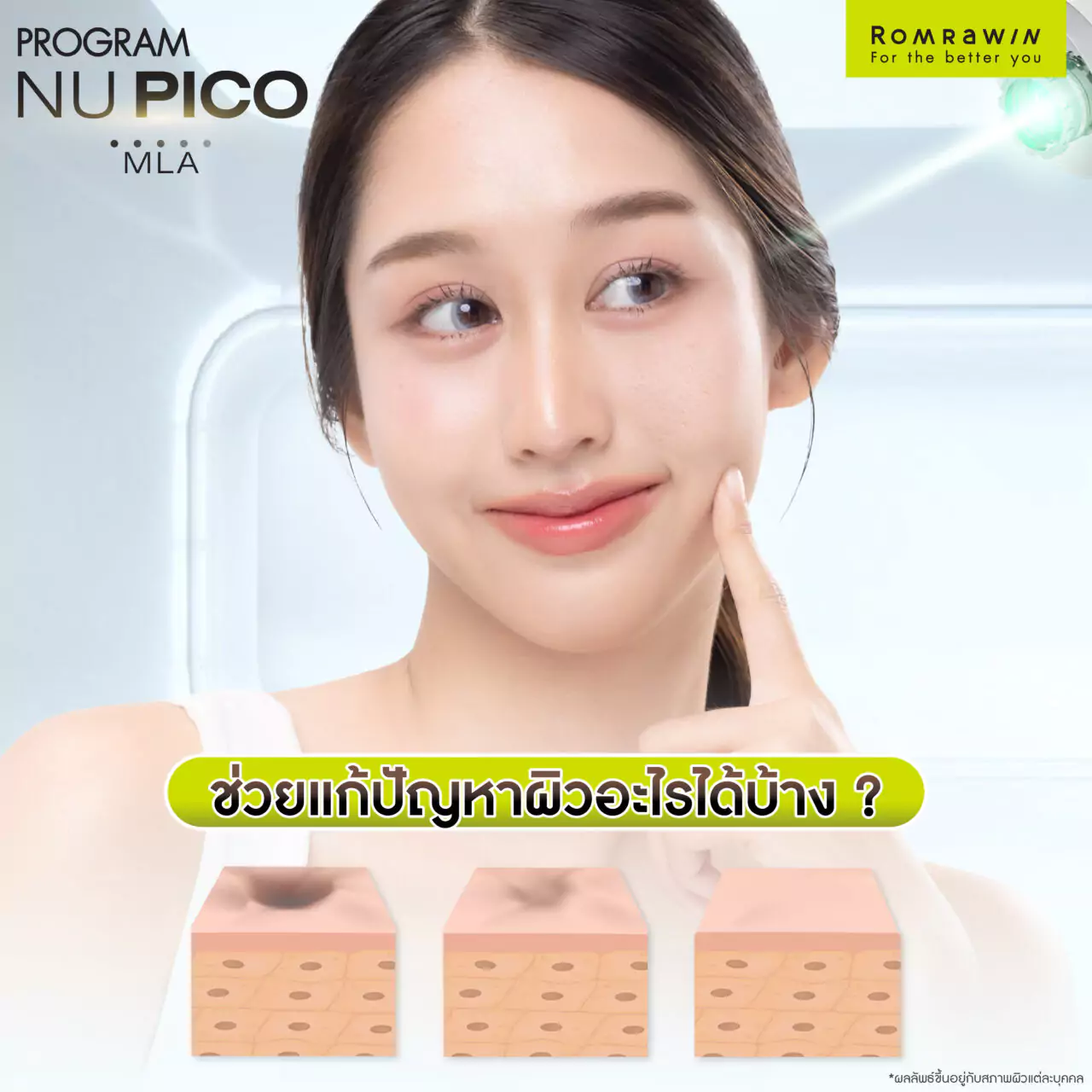 โปรแกรม Nu Pico MLA เลเซอร์หลุมสิว ช่วยแก้ปัญหาผิวอะไรได้บ้าง ?