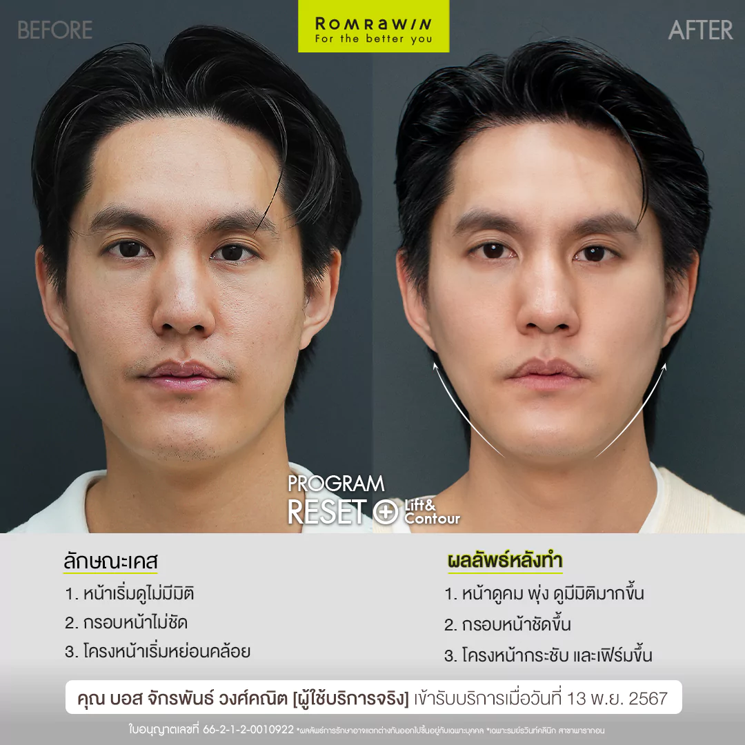Radiesse Plus+ Lift & Contour