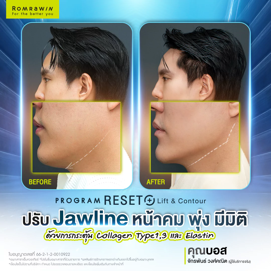 Radiesse Plus+ Lift & Contour
