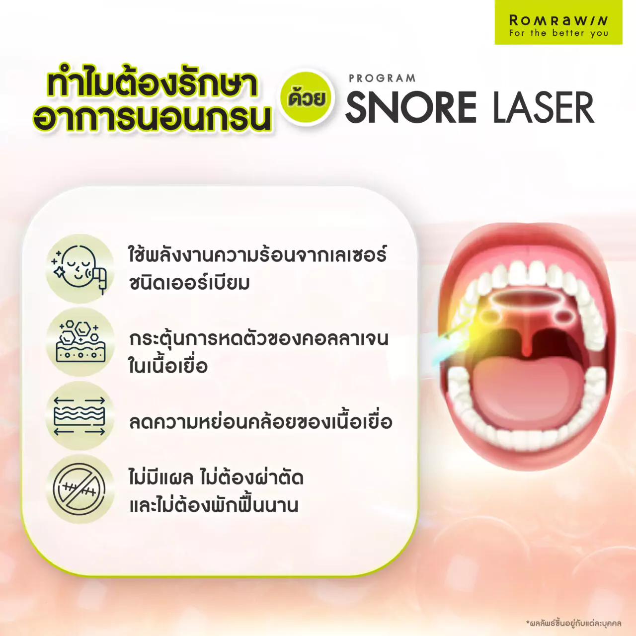 สาเหตุของการนอนกรนที่หลายคนมองข้าม รักษานอนกรนวิธีไหนได้ผล 3 สาเหตุของการนอนกรน : ทำไมต้องรักษานอนกรนด้วยโปรแกรม Snore Laser