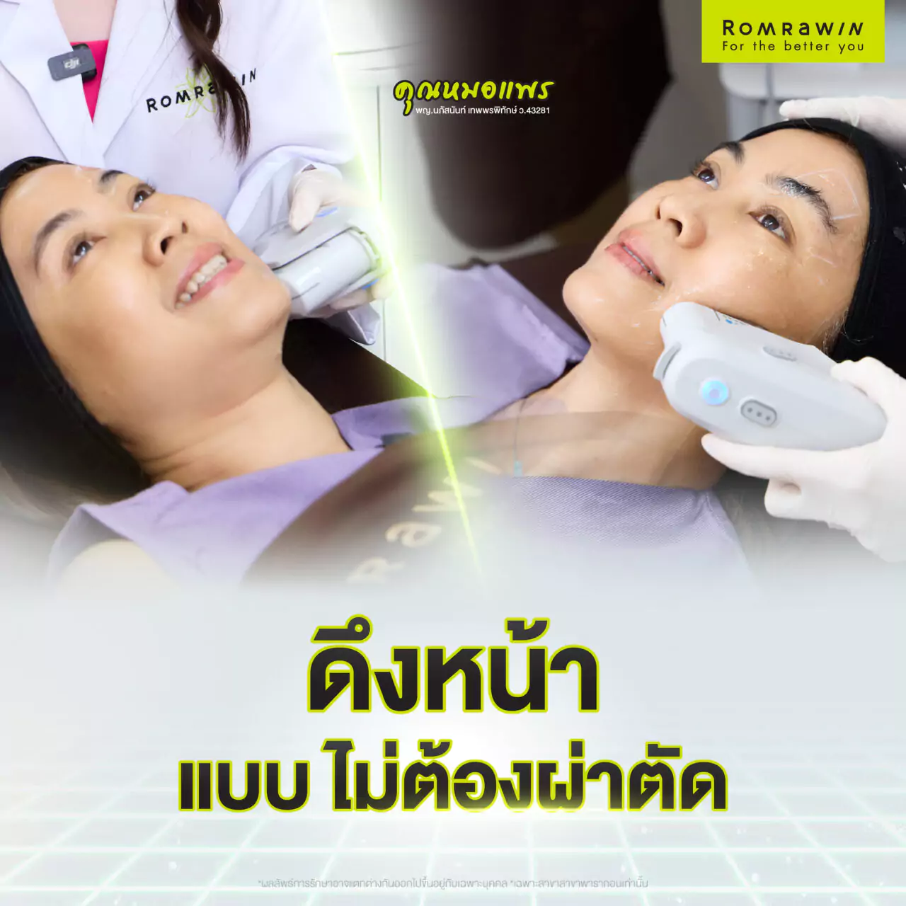 โปรแกรม Ultherapy เปลี่ยนหน้าย้อยของคุณจุ๊ ให้กลายเป็นหน้ายก 2 Ultherapy Prime เปลี่ยนหน้าย้อยให้กลายเป็นหน้ายก