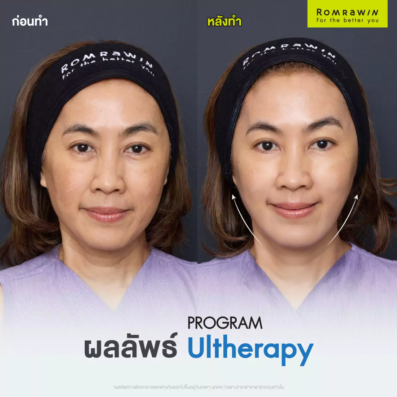 โปรแกรม Ultherapy เปลี่ยนหน้าย้อยของคุณจุ๊ ให้กลายเป็นหน้ายก 3 Ultherapy Prime เปลี่ยนหน้าย้อยให้กลายเป็นหน้ายก