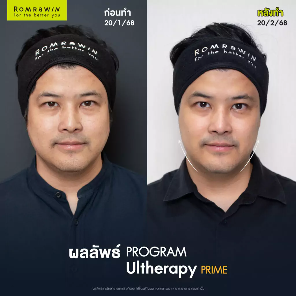 เติ้ล ตะวัน Ultherapy Prime