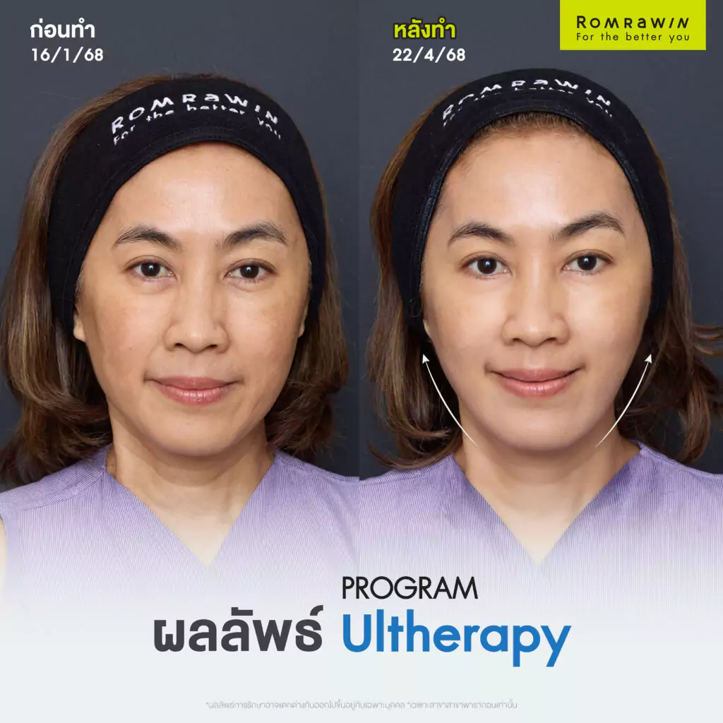 Ultherapy Prime เปลี่ยนหน้าย้อยให้กลายเป็นหน้ายก