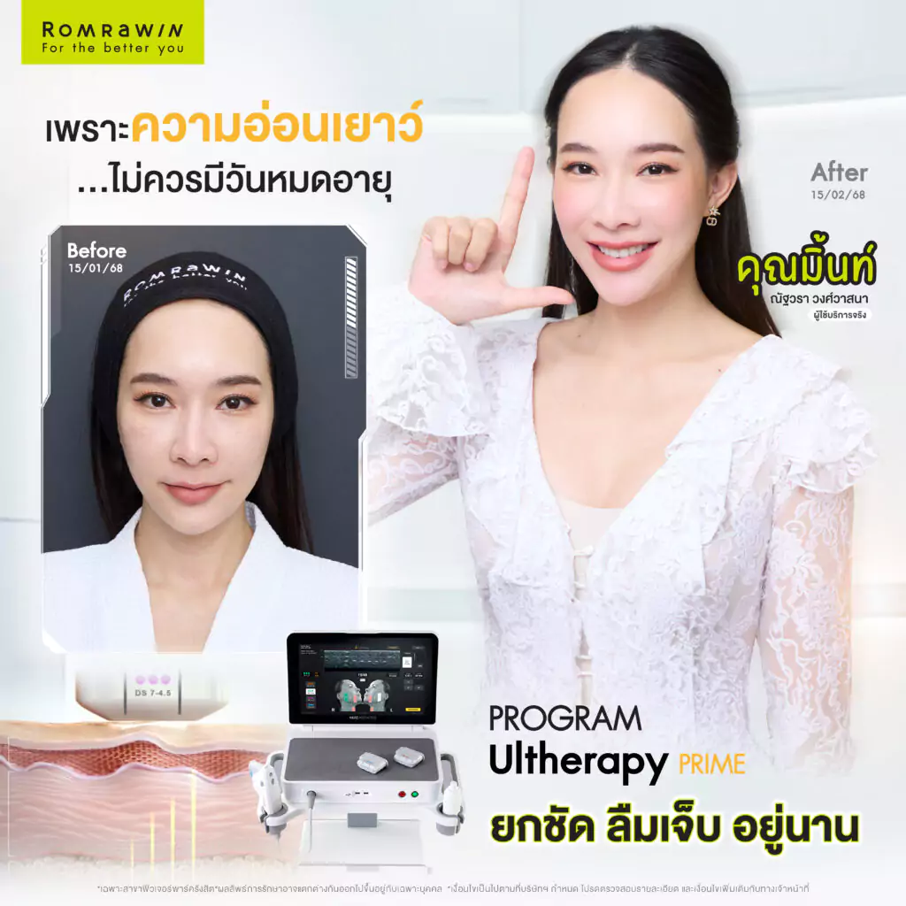 มิ้นท์ ณัฐวรา โปรแกรม Ultherapy Prime
