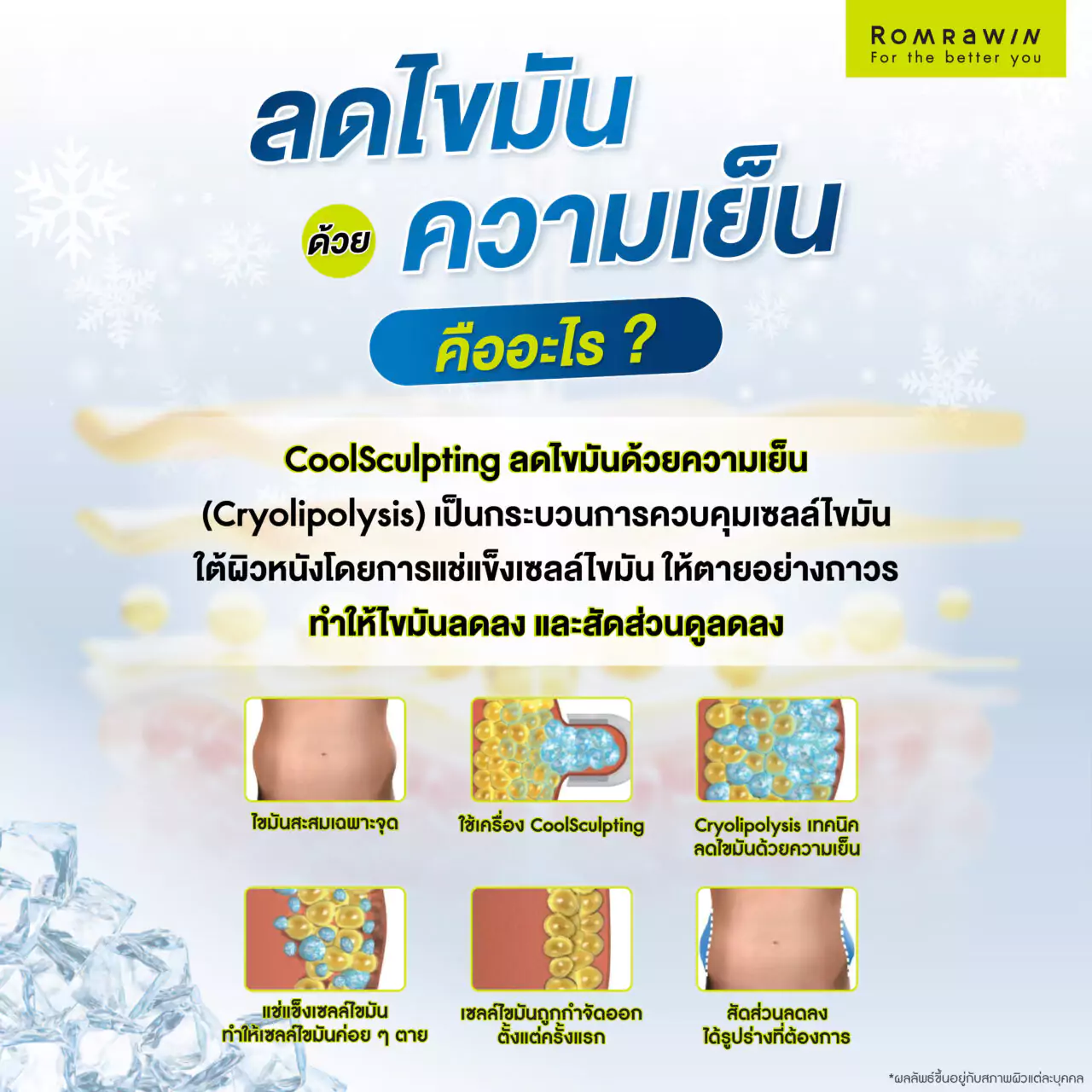 ลดไขมันด้วยความเย็น คืออะไร?