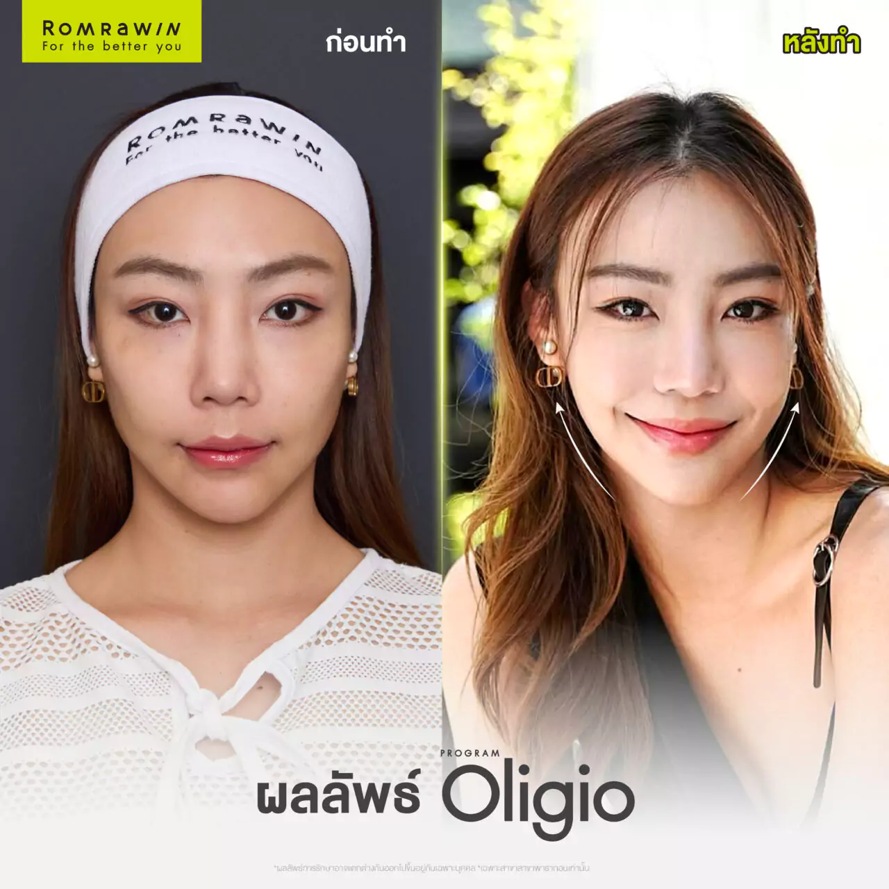 Oligio ลีนเหนียง ยุบแก้ม คุณเดียร์