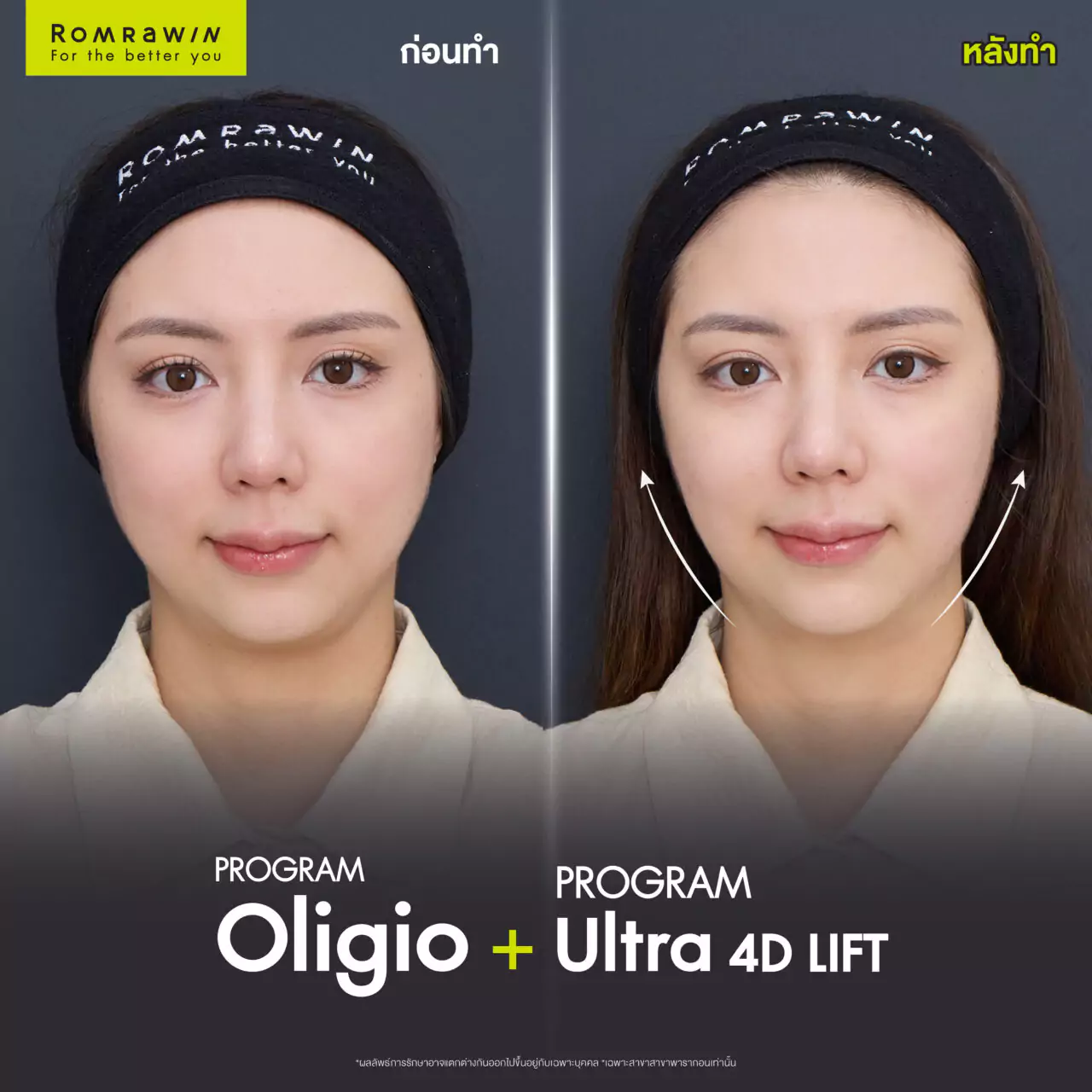 ยกหน้าเรียวกระชับด้วย Oligio และ Ultraformer MPT