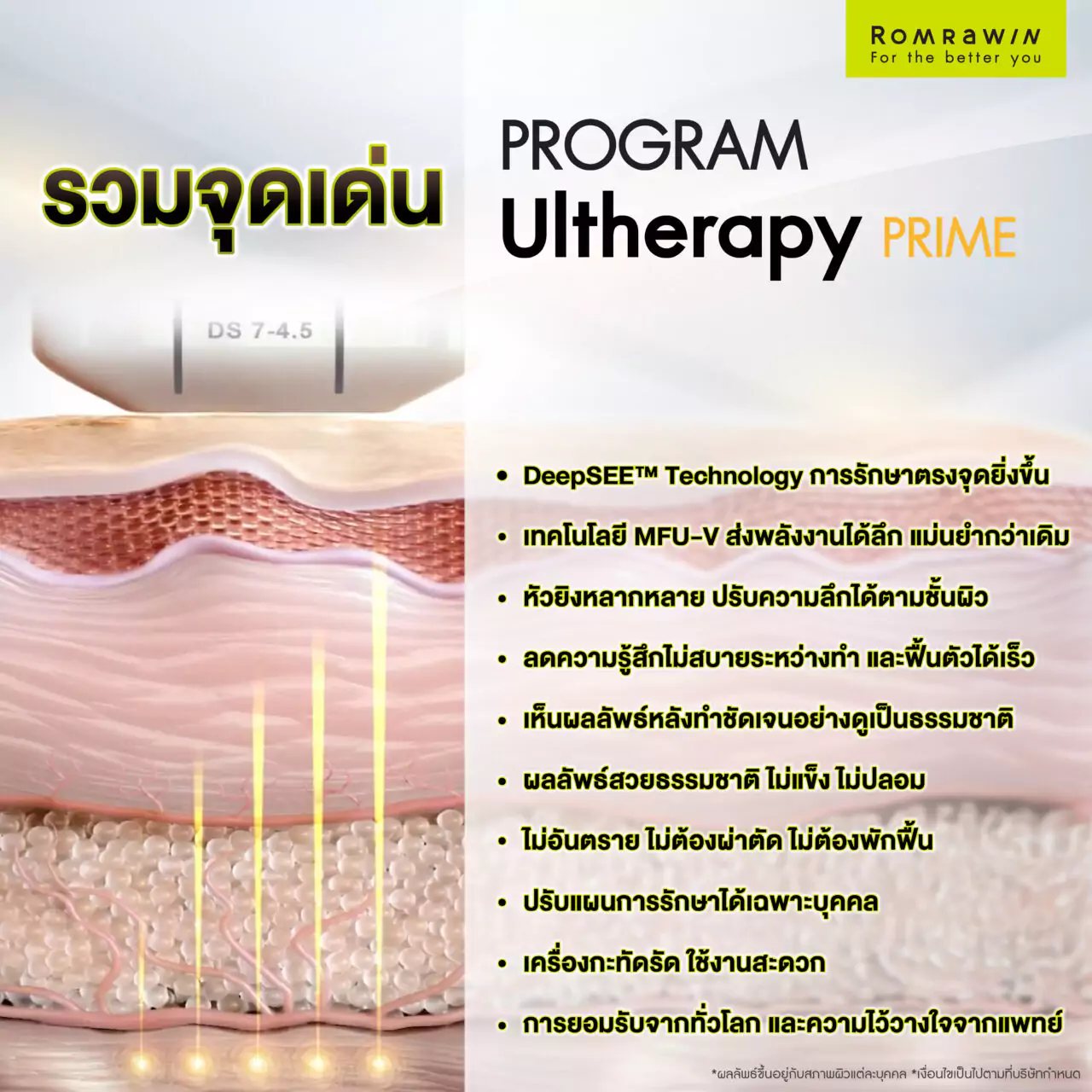 Ultherapy Prime เทคโนโลยียกกระชับที่โดดเด่นที่สุด 2 รวมจุดเด่นของ Ultherapy Prime เทคโนโลยียกกระชับ